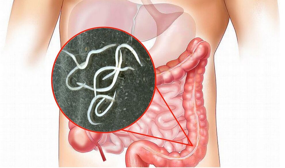 Parassiti nel corpo umano senza trattamento