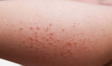 manifestazioni esterne della presenza di parassiti nel corpo